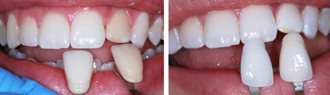 Teeth Whitening