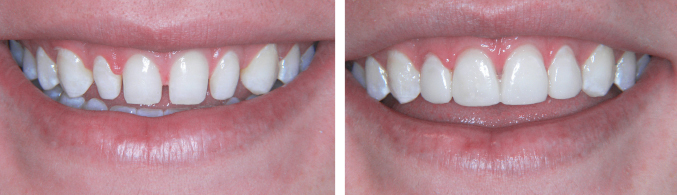 Veneers