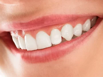 Get a Radiant Smile with Professional Teeth Whitening in Loganville GA