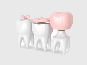 Protect Your Tooth Structure with Inlays & Onlays in Loganville GA