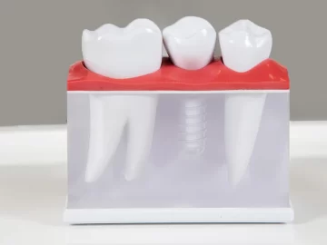 Do I Need Oral Surgery Before Getting Dental Implants?